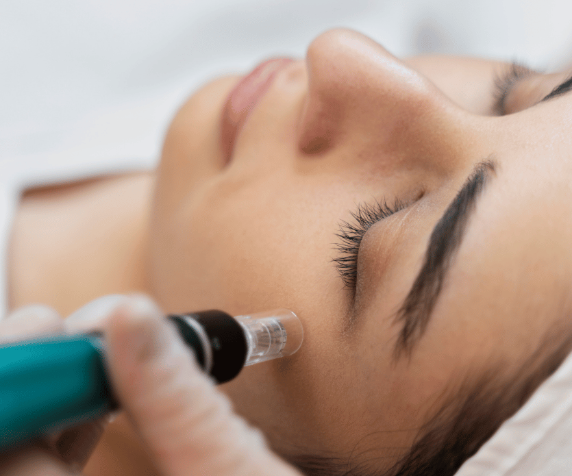 Microneedling treatment aesthetic clinic
